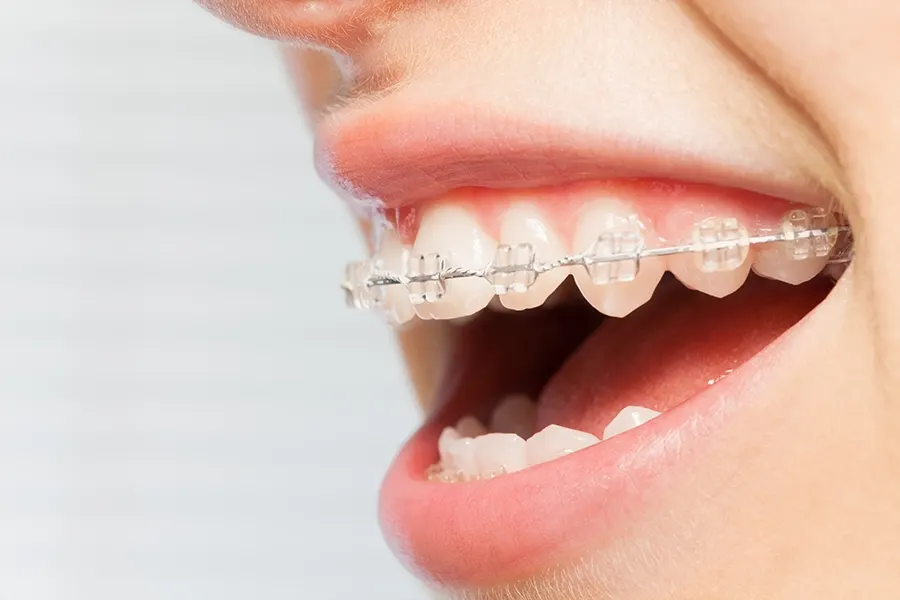 Teeth straightening options at Payne Orthodontics